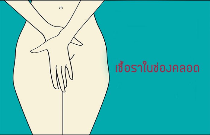 คุณแม่ตั้งครรภ์ระวังเป็นเชื้อราในช่องคลอด คุณแม่ตั้งครรภ์ระวังเป็นเชื้อราในช่องคลอด