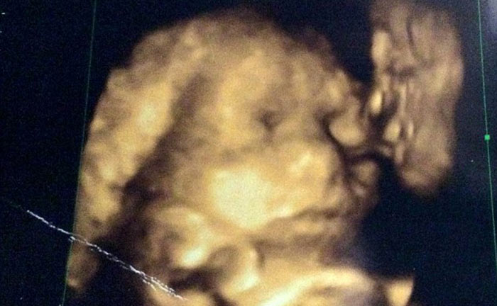 ภาพอัลตร้าซาวด์ปู่จูบทารกในครรภ์